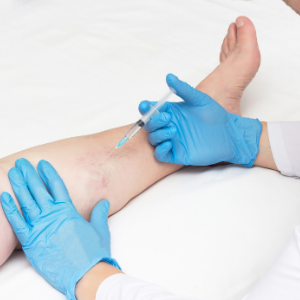 Sclero-Therapy for Spider Veins