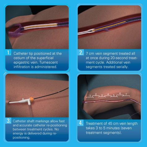 Radio-Frequency Ablation