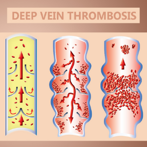 deep vein thrombosis