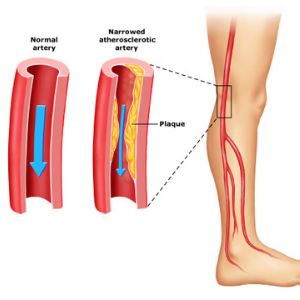 claudication