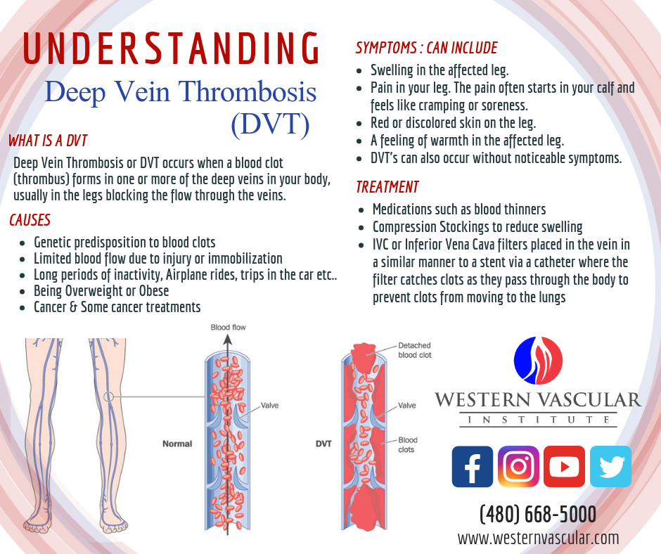 Deep Vein Thrombosis Treatment In Phoenix Arizona