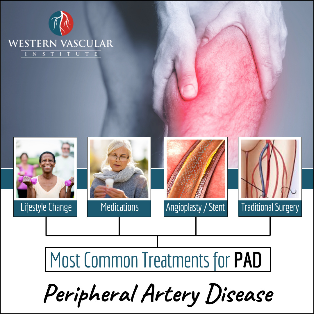 Peripheral Artery Disease Treatments