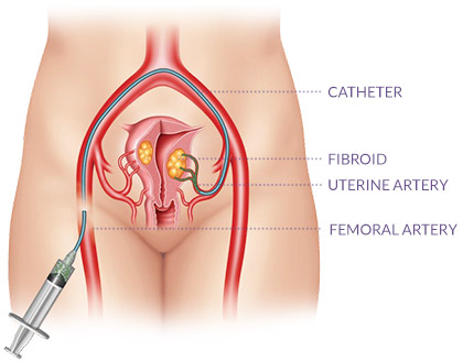What is Uterine Fibroid Embolization or UFE?