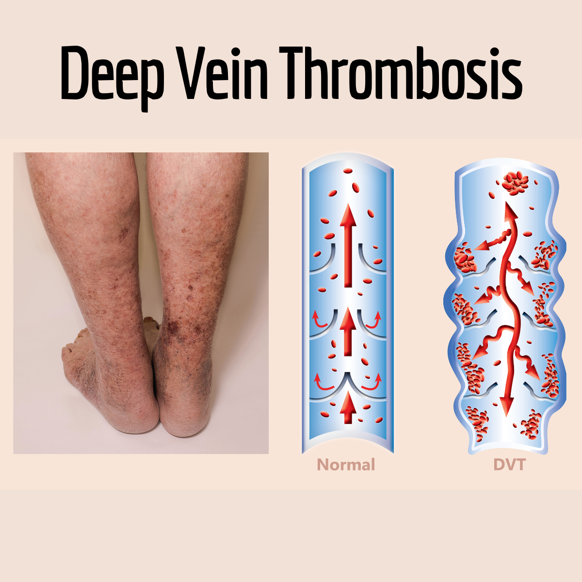 Deep Vein Thrombosis.