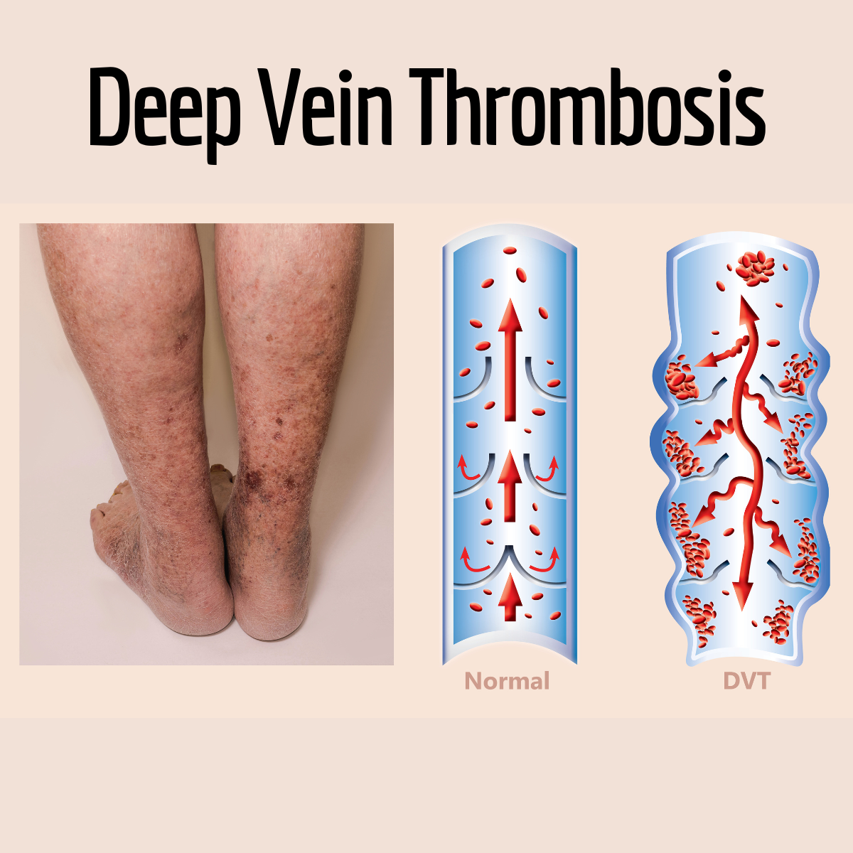 Varicose Vein Treatment - Heart and Vascular Wellness Center