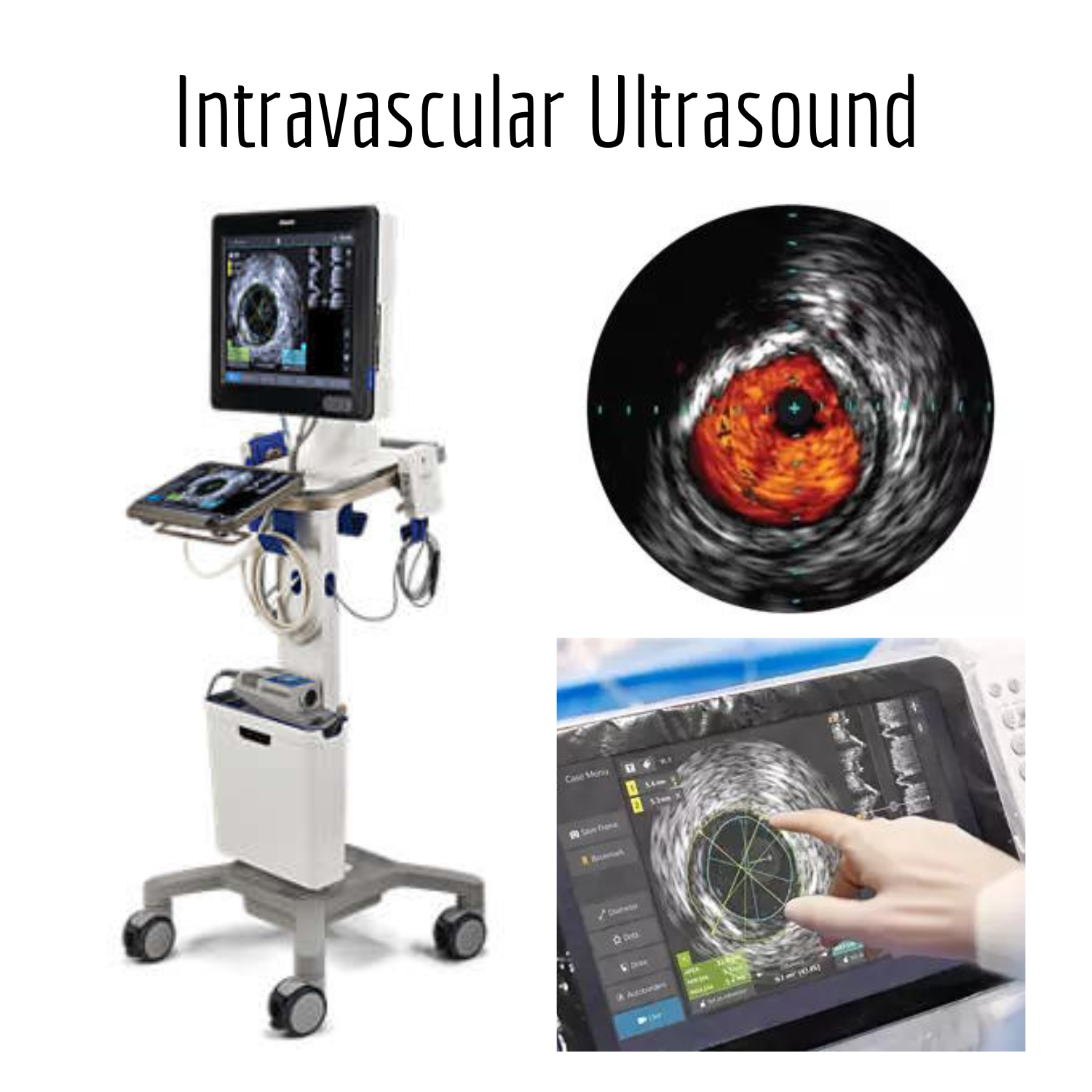 Intravascular Ultrasound (IVUS)