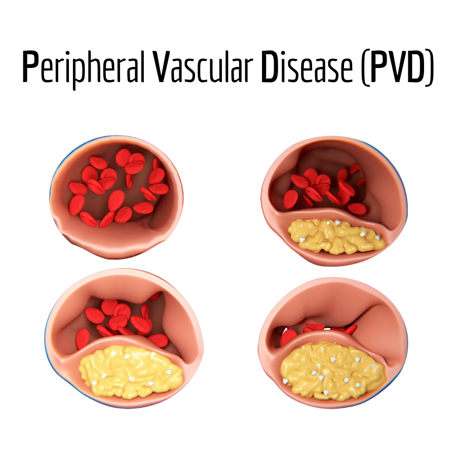 Peripheral Vascular Disease