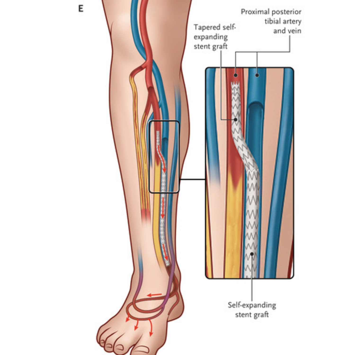 Transcatheter Deep Vein Arterialization